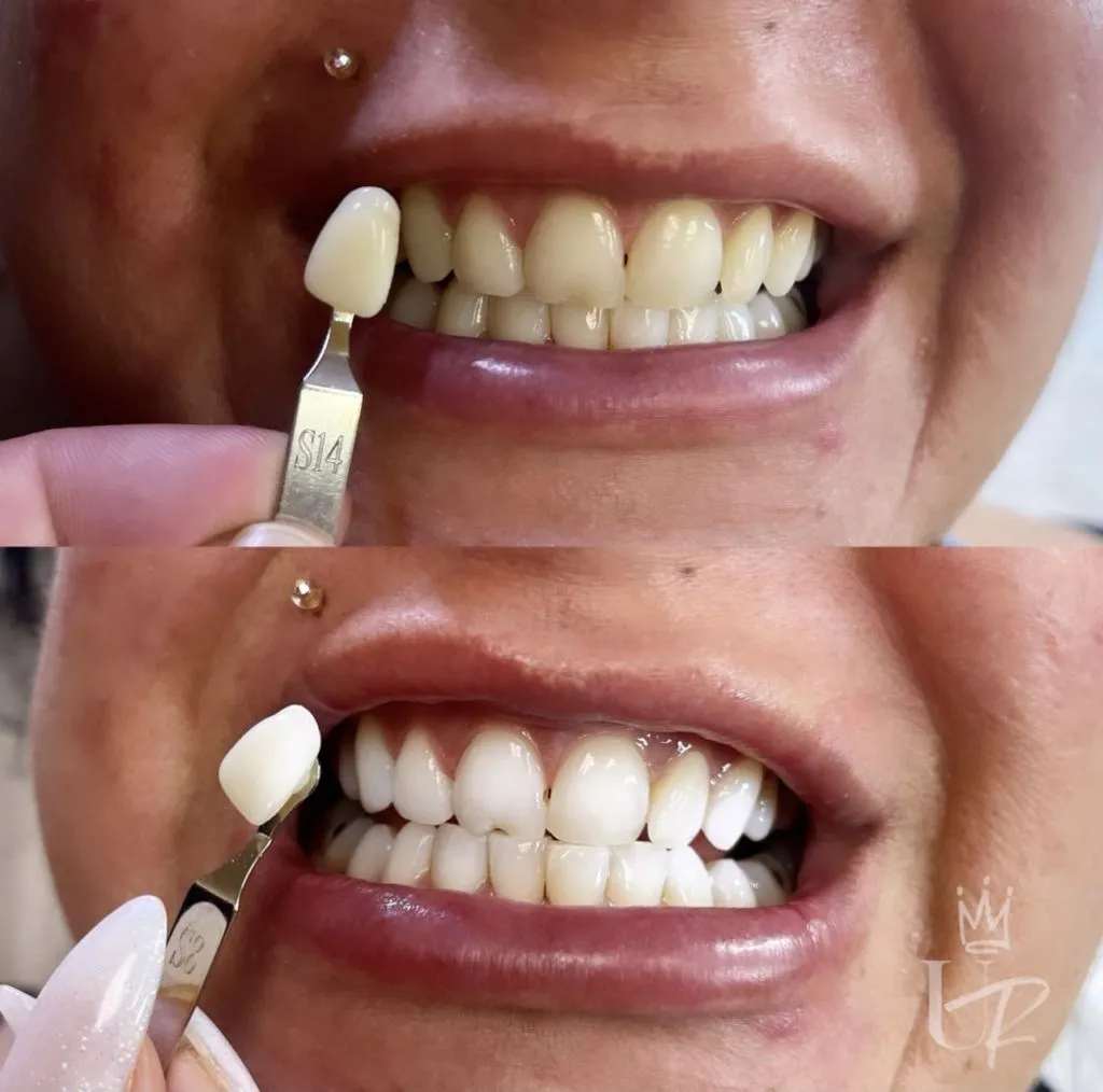 Teeth Whitening